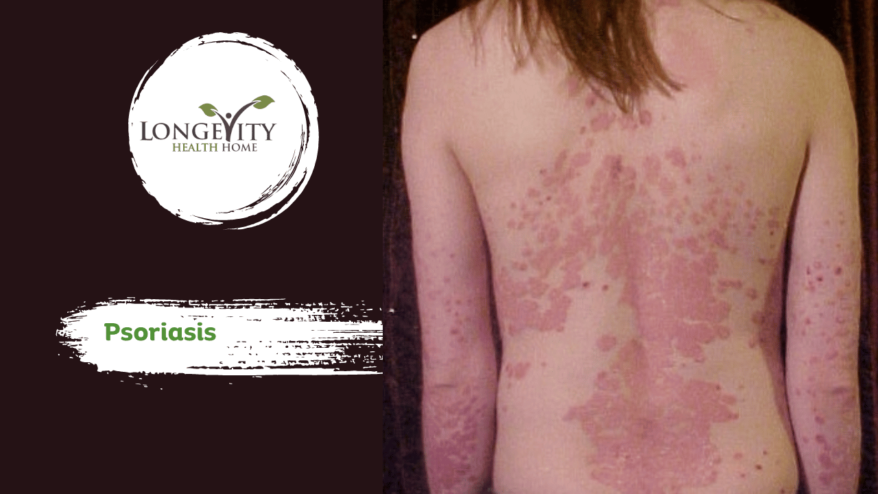 Psoriasis
